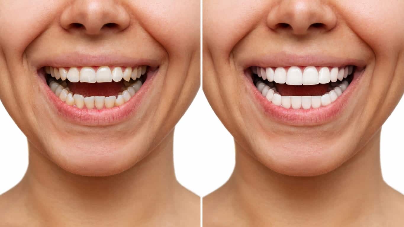 Teeth whitening before and after comparison