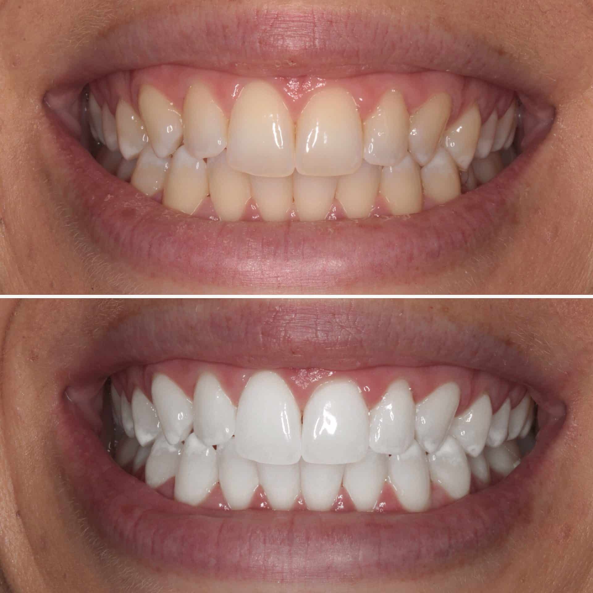 Smile treatment results showing before and after